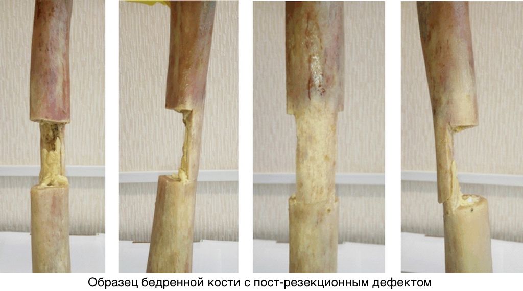 Прогнозирование перелома бедренной кости после хирургической резекции: влияние микроструктуры кортикальной костной ткани